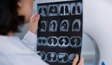 Uzmanından uyarı: ‘Kan sulandırıcı kullanımı beyin kanaması riskini artırabilir’