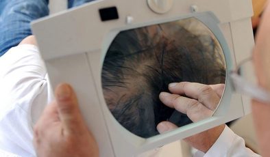 ‘Saç ekimi’ davasında emsal karar: Mahkeme ayıplı işlem olarak kabul etti; ücret iadesine karar verdi